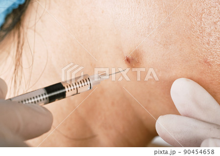 Cystic acne injection treatment, Facial skin problem, Acne disease in adult, Close up woman face 90454658