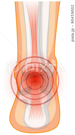 Achilles tendo rupture on white background Achilles tendo rupture on white background 90459002