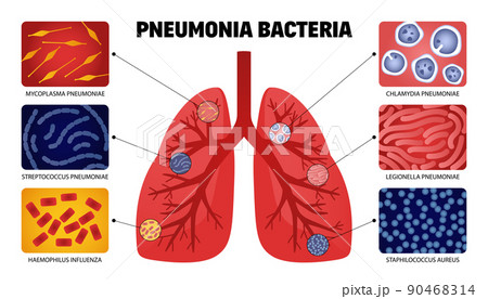 Pneumonia Bacteria Lungs Collection 90468314