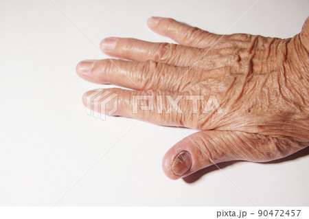 Fingernail of an elderly woman infected with fungal infection. 90472457