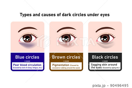 目のくま（眼のクマ) の種類と原因 ベクターイラスト (英語) 90496495