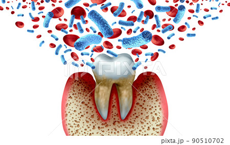 Tooth Decay Blood Bacteria 90510702