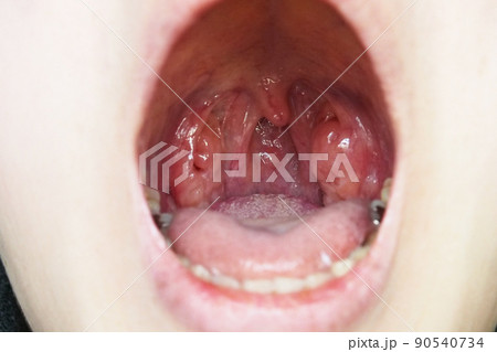 扁桃腺肥大 90540734