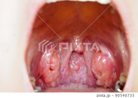 扁桃腺の腫れ 扁桃腺の腫れ 90540735