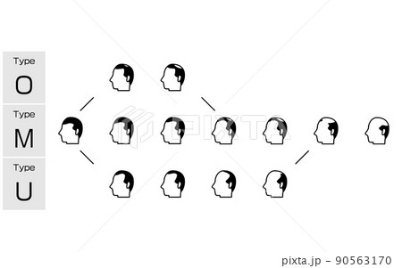AGA　男性型脱毛症の各タイプと進行ステージのイラスト 90563170
