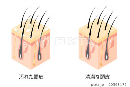汚れた頭皮と清潔な頭皮の断面図の図解イラスト、アイソメトリック 汚れた頭皮と清潔な頭皮の断面図の図解イラスト、アイソメトリック 90563175