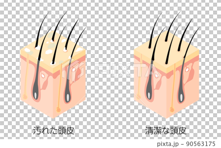 Illustrated illustration, isometric of cross section of dirty scalp and clean scalp 90563175