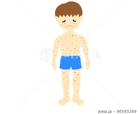 肌に疾患のある男の子 肌に疾患のある男の子 90583269