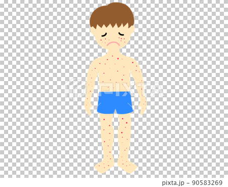 肌に疾患のある男の子 肌に疾患のある男の子 90583269