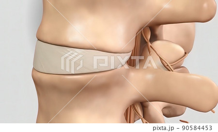 Crushing of the plaque in the spinal cord as a result of pressure Crushing of the plaque in the spinal cord as a result of pressure 90584453