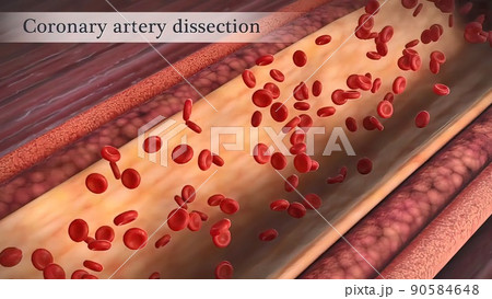Coronary artery spasm is a brief, sudden narrowing of one of these arteries. Coronary artery spasm is a brief, sudden narrowing of one of these arteries. 90584648