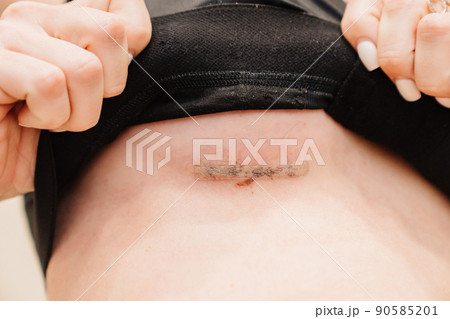 surgical sewing. A young woman in black compression underwear after mammoplasty. surgical sewing. A young woman in black compression underwear after mammoplasty. 90585201