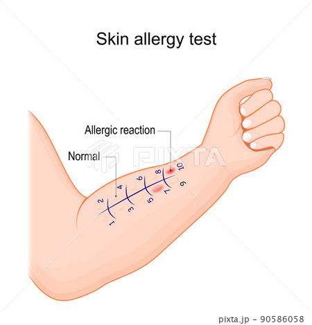 Skin allergy test. Human arm with allergen. Skin allergy test. Human arm with allergen. 90586058