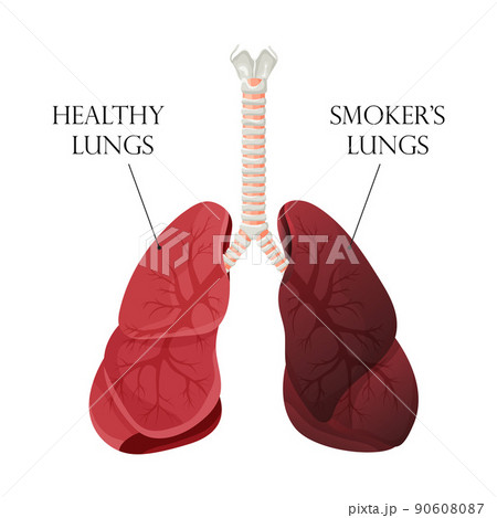 Illustration of normal healthy lungs and lungs smoker. Concept of stop smoking. Vector illustration. Illustration of normal healthy lungs and lungs smoker. Concept of stop smoking. Vector illustration. 90608087