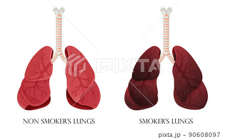 Illustration of normal healthy lungs and lungs smoker. Concept of stop smoking. Vector illustration. Illustration of normal healthy lungs and lungs smoker. Concept of stop smoking. Vector illustration. 90608097