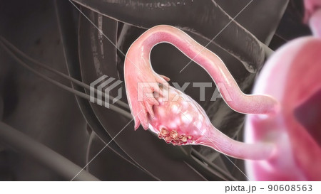 Ovarian cancer is a disease in which cells in the ovaries multiply and grow abnormally. 90608563
