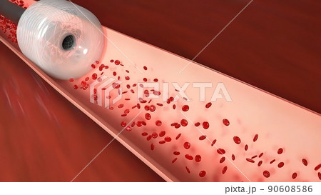 Vascular occlusion is a blockage of a blood vessel, usually with a clot. Vascular occlusion is a blockage of a blood vessel, usually with a clot. 90608586