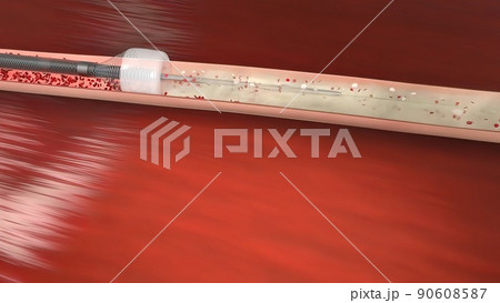 Vascular occlusion is a blockage of a blood vessel, usually with a clot. 90608587