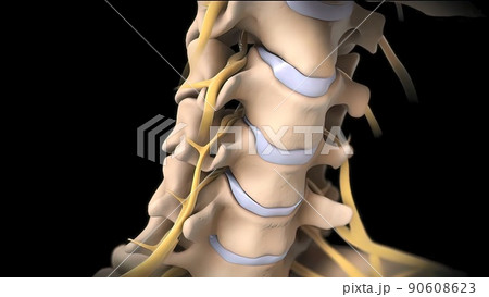 Pressure applied to the nerve as a result of the fracture of the spinal disc 90608623