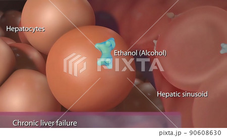 Chronic liver failure caused by the hepatitis B virus. 90608630