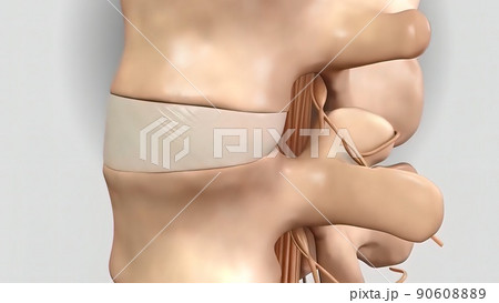Crushing of the plaque in the spinal cord as a result of pressure Crushing of the plaque in the spinal cord as a result of pressure 90608889