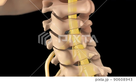 Anatomical view of the cervical spine with intervertebral disc-compressive nerve root prolapse Anatomical view of the cervical spine with intervertebral disc-compressive nerve root prolapse 90608943