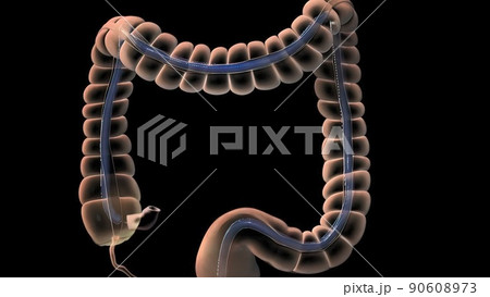 Colonoscopy Biopsy Of The Gastrointestinal Tract In Patients 90608973