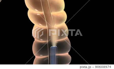 Colonoscopy Biopsy Of The Gastrointestinal Tract In Patients 90608974
