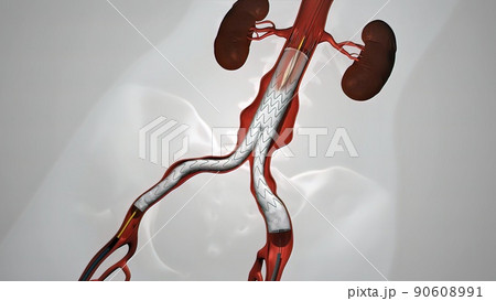 balloon angioplasty procedure with stent in vein 90608991