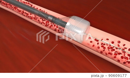 Vascular occlusion is a blockage of a blood vessel, usually with a clot. Vascular occlusion is a blockage of a blood vessel, usually with a clot. 90609177
