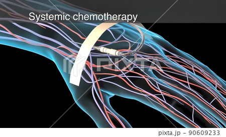 Chemotherapy is applied to the tumor areas and the tumor is cleared. 90609233