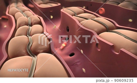 Atherosclerosis: Cholesterol Plaque In Artery 90609235