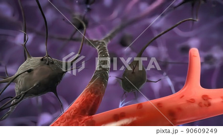 Vascular occlusion is a blockage of a blood vessel, usually with a clot, heart attack 90609249