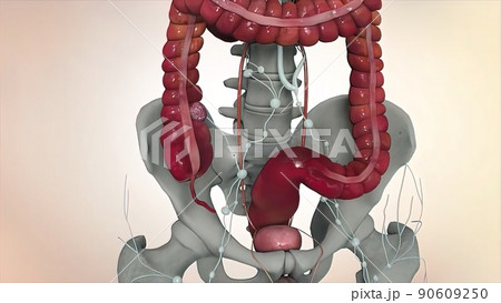 Colon during a enteroscopy with a intestinal or bowel cancer tumor visible. 90609250