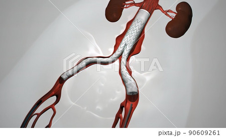 balloon angioplasty procedure with stent in vein balloon angioplasty procedure with stent in vein 90609261