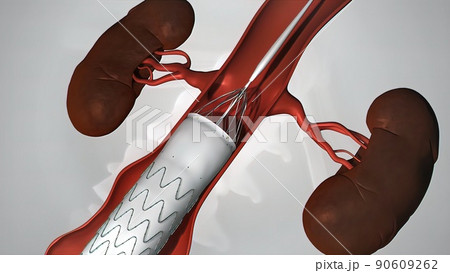 balloon angioplasty procedure with stent in vein 90609262