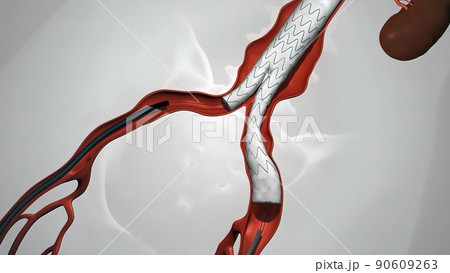 balloon angioplasty procedure with stent in vein 90609263
