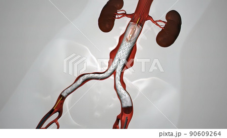 balloon angioplasty procedure with stent in vein 90609264