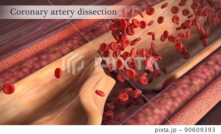 Coronary artery spasm is a brief, sudden narrowing of one of these arteries. 90609393