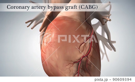 Coronary artery bypass surgery is done using a healthy blood vessel called a graft. Coronary artery bypass surgery is done using a healthy blood vessel called a graft. 90609394
