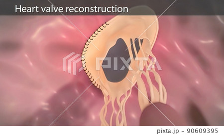 Coronary artery bypass surgery is done using a healthy blood vessel called a graft. Coronary artery bypass surgery is done using a healthy blood vessel called a graft. 90609395