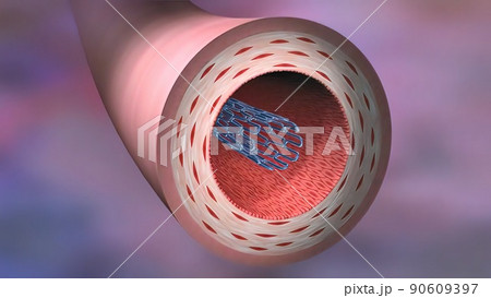 The term angioplasty means using a balloon to stretch open a narrowed The term angioplasty means using a balloon to stretch open a narrowed 90609397