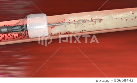 Vascular occlusion is a blockage of a blood vessel, usually with a clot. 90609442