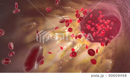 Clogging of the arteries with plaque Clogging of the arteries with plaque 90609498