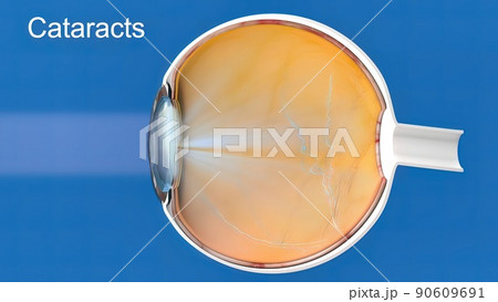 Cataract, clouding of the lens of the eye that causes decreased vision. 90609691