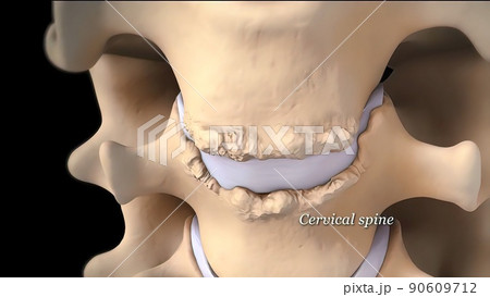 Removing the damaged disc and replacing it with metal discs 90609712