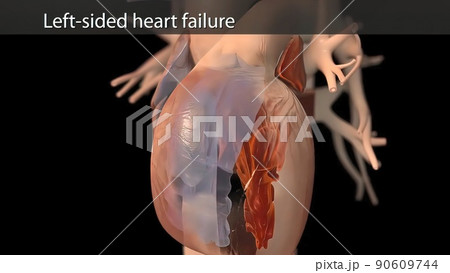 illustration Congestive Heart Failure 90609744