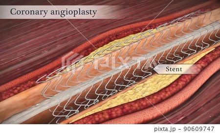 Coronary angioplasty opens narrowed coronary arteries. 90609747