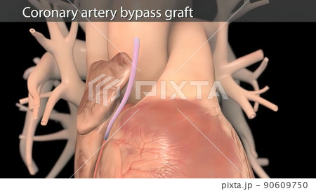 Coronary artery bypass surgery is done using a healthy blood vessel called a graft. 90609750