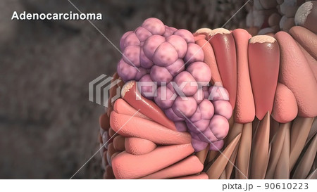 Division and growth of cancerous cells Division and growth of cancerous cells 90610223